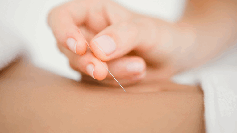 Person receiving acupuncture at Health For Life Naturopathic Medicine in Phoenix, AZ