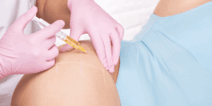 A woman receiving a PRP treatment in her hip area at Health For Life Naturopathic Medicine in Phoenix, AZ